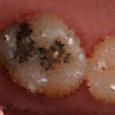 Level 36 Answer 8 - dental filling